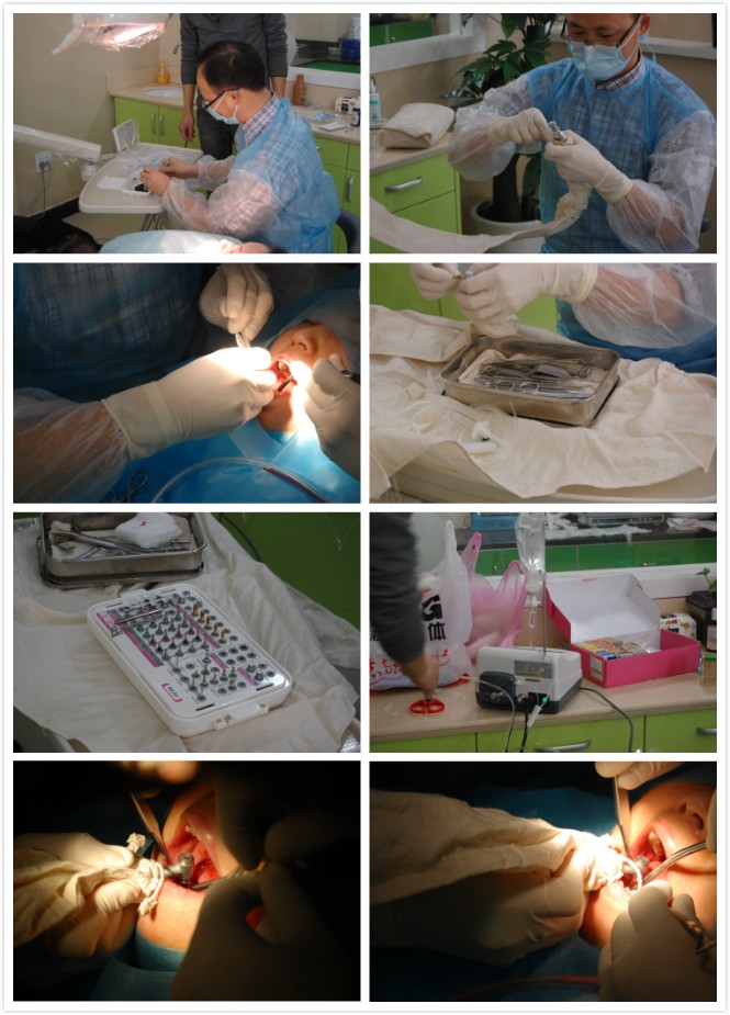 嵊州沈氏牙科诊所1月27日一例种植牙病历报告，一台右下6、7种植手术，患者女性，51岁了，保养得很好，本人对牙齿要求也高，所以选择种植牙修复缺失牙，总共耗时半小时，手术很成功。