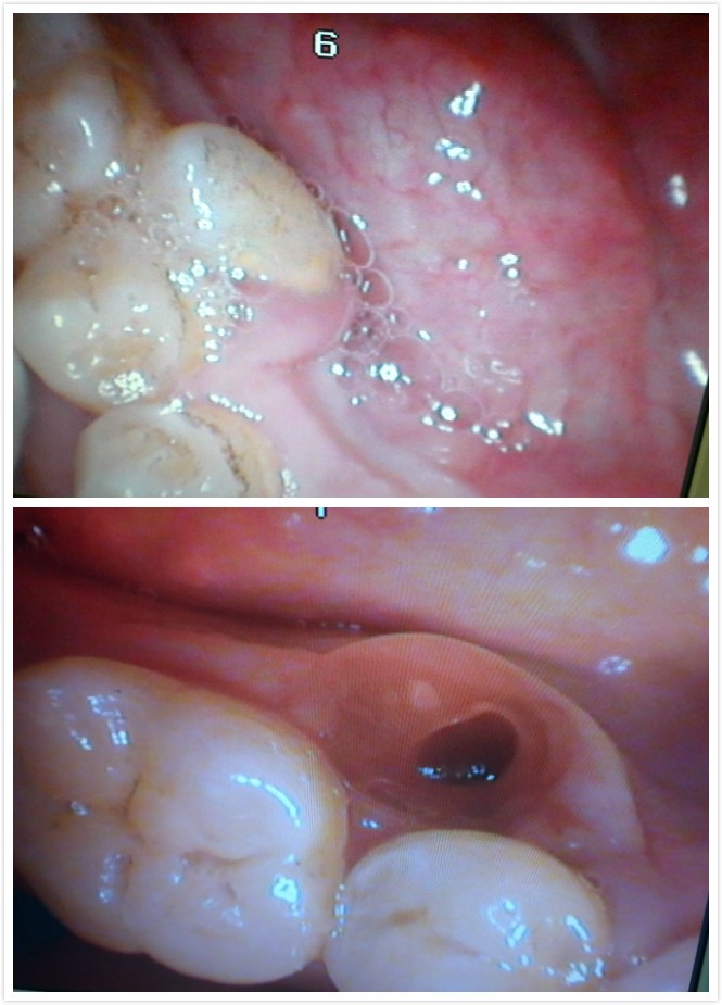 多生牙拔除前后对比.jpg