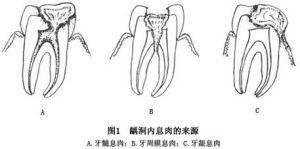 牙髓息肉的三种来源